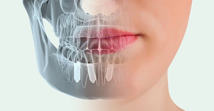 10-preguntas-frecuentes-que-debes-saber-sobre-implantes-dentales