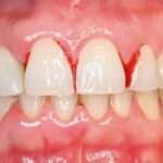 Cepillado dental con brackets: ¡los mejores consejos para una limpieza impecable! cepillado-dental-con-brackets-los-mejores-consejos-para-una-limpieza-impecable