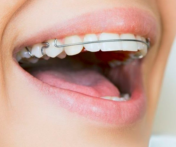 consecuencias-de-retirar-la-ortodoncia-antes-de-tiempo-cuidado