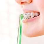 consejos-para-cuidar-tu-salud-bucal-mientras-usas-brackets-no-te-los-pierdas