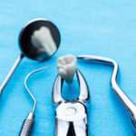 Cuidados después de un empaste dental: consejos importantes cuidados-despues-de-un-empaste-dental-consejos-importantes