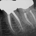 Endodoncia: ¿cuánto tiempo dura y qué debes esperar? endodoncia-cuanto-tiempo-dura-y-que-debes-esperar