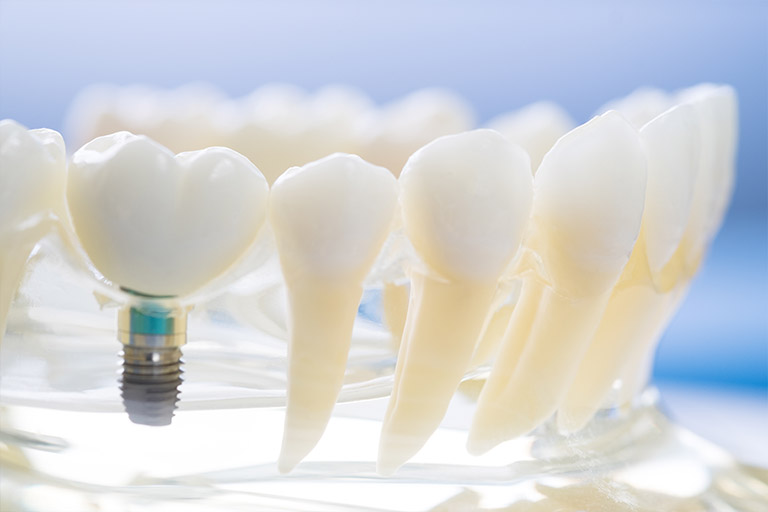implantes-cigomaticos-conoces-esta-alternativa-innovadora-para-reemplazar-tus-dientes