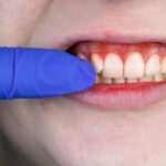 implantes-dentales-descubre-el-proceso-las-fases-y-los-tiempos-involucrados