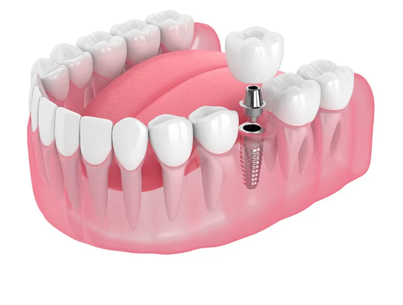 implantes-dentales-vs-protesis-dentales-conoce-la-diferencia