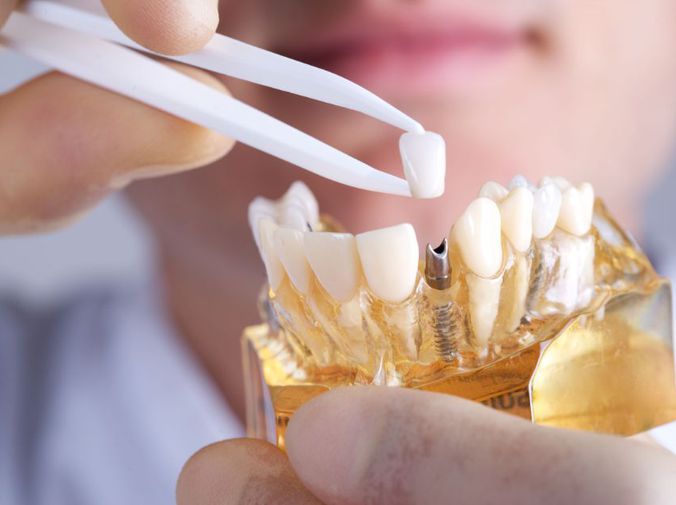 odontologia-adhesiva-la-tecnica-revolucionaria-que-mejora-tu-sonrisa