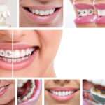 Ortodoncia lingual: la solución invisible para una sonrisa perfecta ortodoncia-lingual-la-solucion-invisible-para-una-sonrisa-perfecta