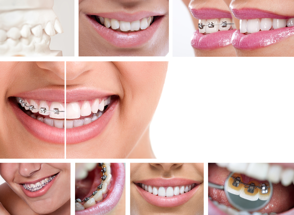 ortodoncia-lingual-la-solucion-invisible-para-una-sonrisa-perfecta