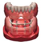 protesis-sobre-implantes-recupera-tu-sonrisa-con-esta-solucion-innovadora
