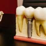 que-tener-en-cuenta-antes-de-un-implante-dental-informacion-clave