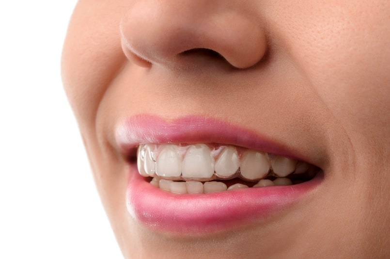 recupera-tu-sonrisa-tratamientos-efectivos-para-la-perdida-de-esmalte-dental