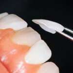 todo-lo-que-necesitas-saber-sobre-la-resina-dental