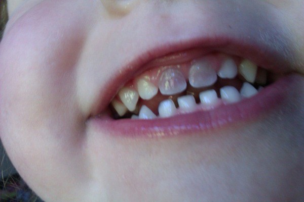 todo-sobre-la-caries-infantil-protege-los-dientes-de-tus-hijos